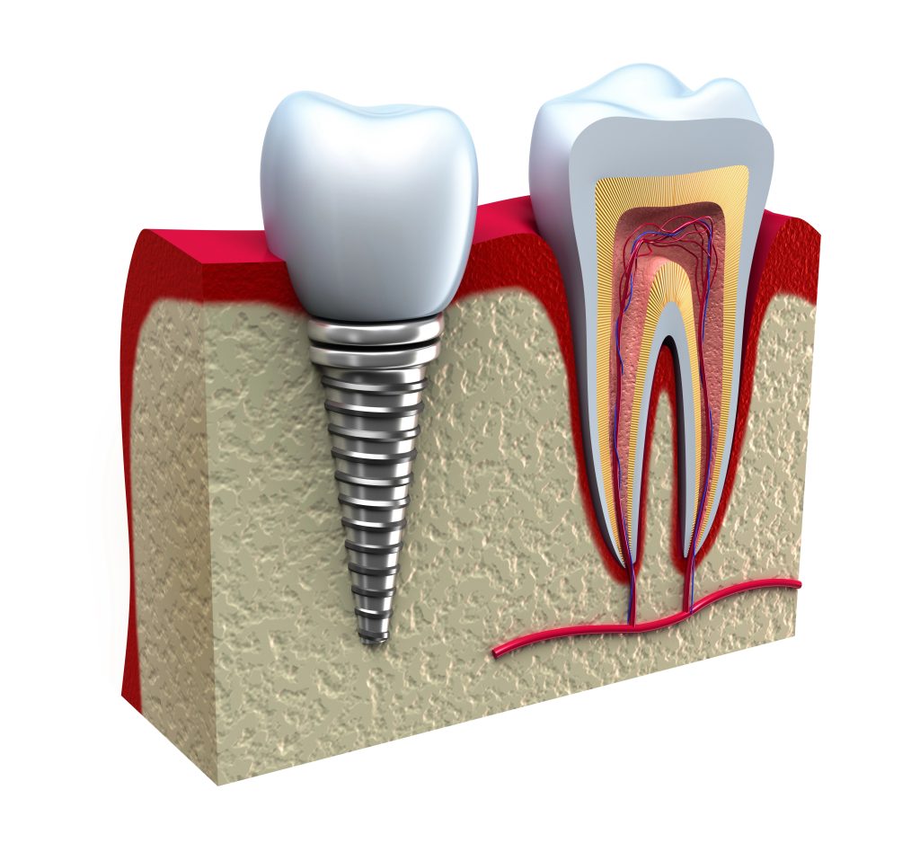 Olympia Dental implants
